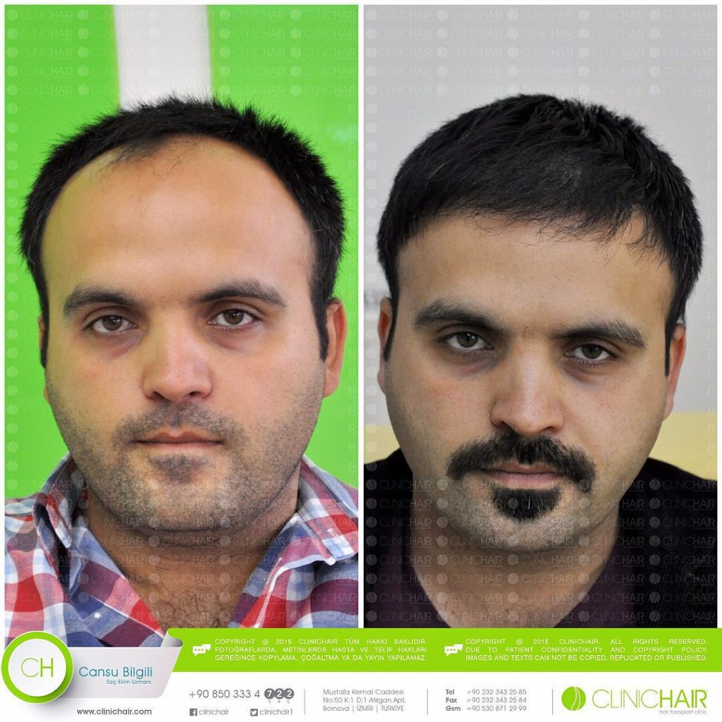 BEFORE & AFTER - Hair Transplant Turkey